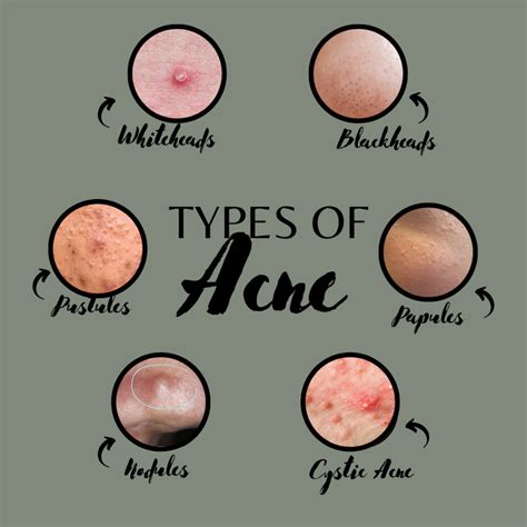 Acne Awareness Month June Emma Hart Aesthetics