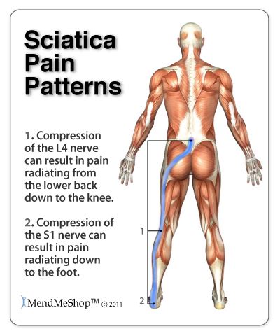 Treating Sciatica Pain