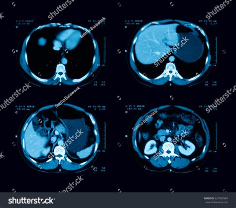 Computed Tomography Ct Scan Abdomen Contrast Stock Photo 627993584 ...