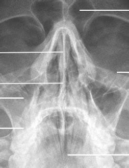 Radr Parietoacanthial Projection Waters Method Nasal Bones