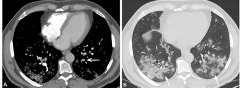 Ctpa Images On The Axial Planes Ct Staging System Stage 4 A Window