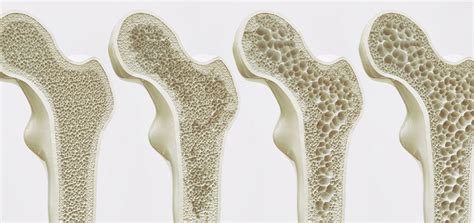 Osteoporosis Infusion Medications: What is Right for You? - PHO