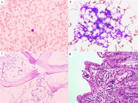 (A) Peripheral blood smear of the patient showing pancytopenia ...