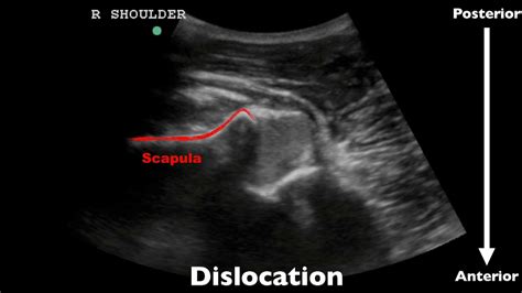 Pocus Evaluating For Shoulder Dislocation With Ultrasound Youtube