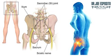 Understanding the Connection: Can Hip Arthritis Cause SI Joint Pain ...