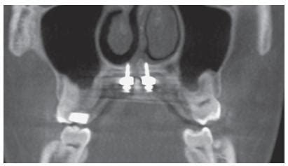 Scielo Brasil Mini Implant Selection Protocol Applied To Marpe Mini