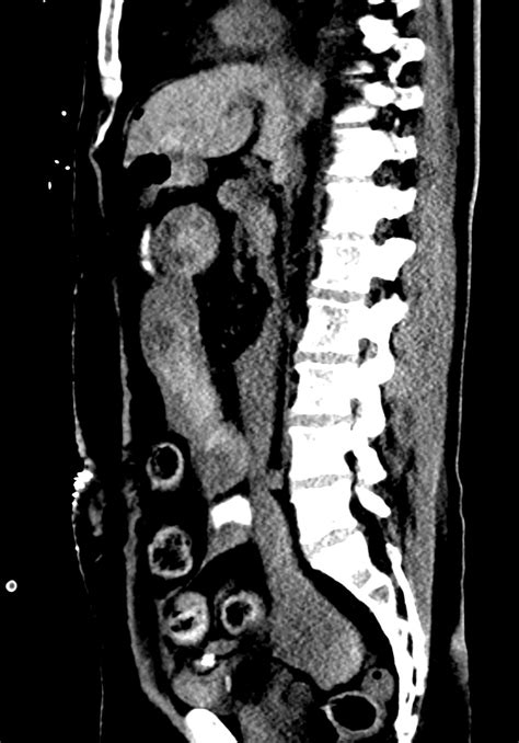 Spontaneous Small Bowel Intramural And Intraluminal Hematoma Image