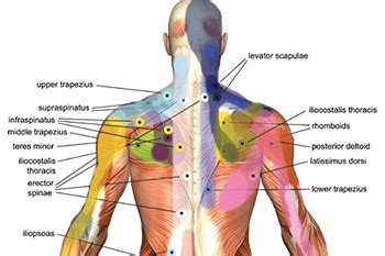 Supraspinatus Triggerpoint Online Emergencydentistry