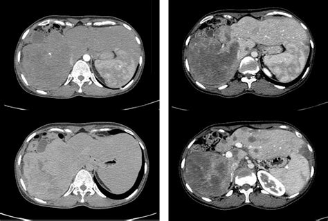 Malignant Hepatic Epithelioid Hemangioendothelioma With Villaret