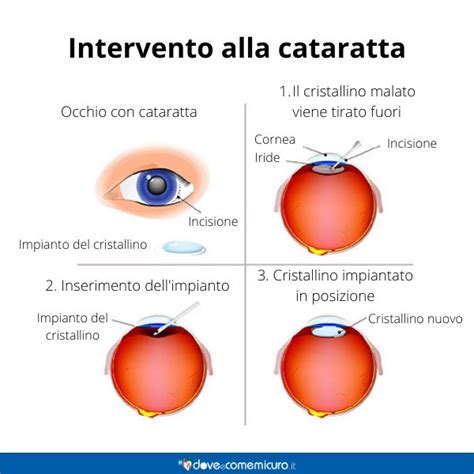 Cataratta Sintomi Premonitori E Quando Operare A Anni