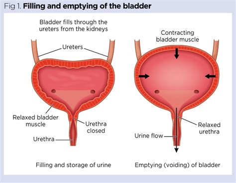 Urinary Catheters Teaching Patients How To Use A Catheter Valve