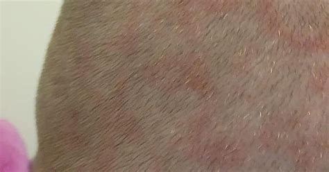 Scalp Rash Album On Imgur