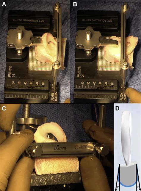 The Lateral Meniscal Allograft Transplantation System Conmed Provides