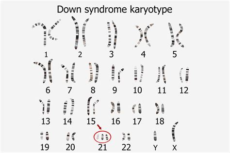 Down Syndrome Chromosome Chart