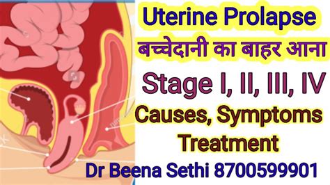 Uterine Prolapse Stage Causes Symptoms Treatment बच्चेदानी का बाहर आना Pregahealthtips1973