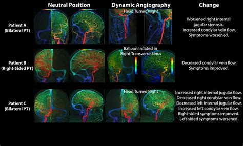 Pulsatile Tinnitus Causes & Treatments (2022)