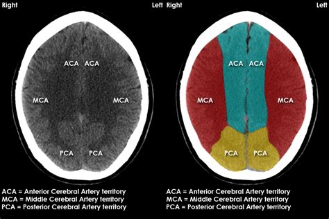 Arteries Of The Brain