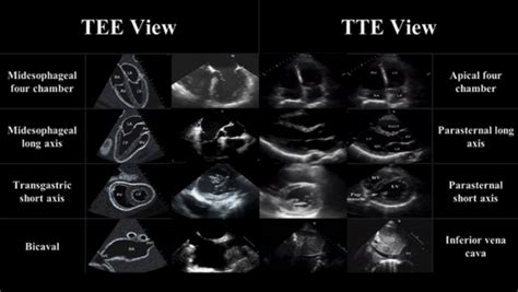 Resuscitative TEE — Maimonides Emergency Medicine Residency