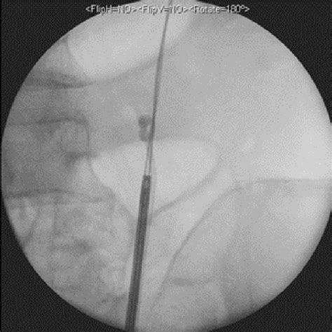 Xr Kub Position Of Left Dj Stent Prior To Removal Download Scientific