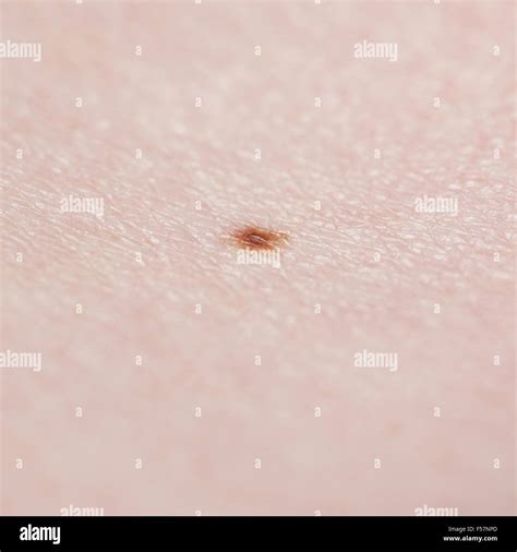 Skin mole hi-res stock photography and images - Alamy