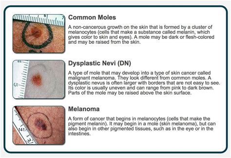 Cancerous Moles Vs Normal Moles