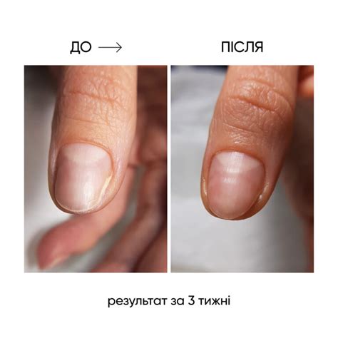 NAILSOFTHEDAY ONISTOP – регенеруюча олія проти оніхолізису, 15 мл ...