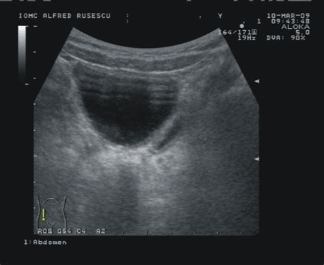 Diverticulum of urinary bladder. | Download Scientific Diagram