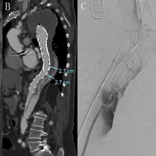 Multiplanar Reconstruction Of Ct Scan Showing The Measurement Of The