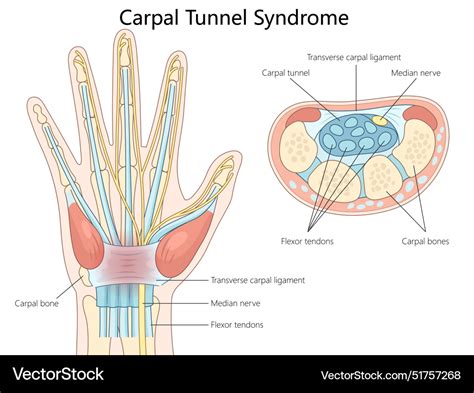 Carpal Tunnel Syndrom Anatomie Diagramm Medizinische