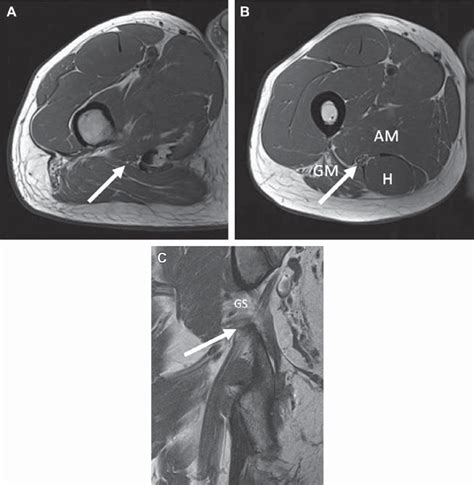 Normal sciatic nerve. (A) Axial T1 MR images, just below the greater ...