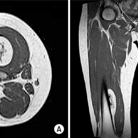 Magnetic Resonance Image Under The Intermediate Vastus Medialis Download Scientific Diagram