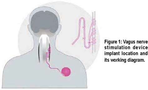 Figure 1 From Vagus Nerve Stimulation For Treatment Resistant