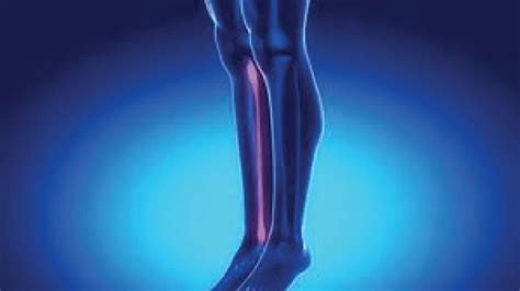 Sprained ankle: symptoms, causes, treatment, and recovery time