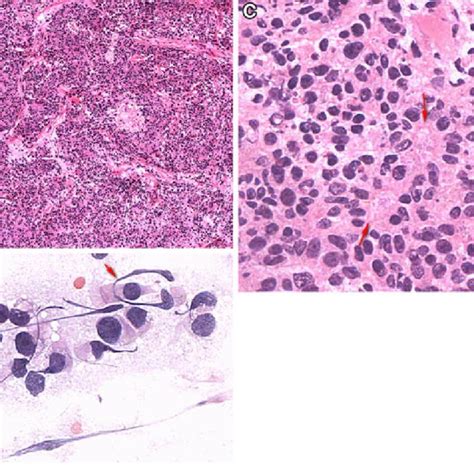 Frozen Section Shows A Cellular Tumor Forming Sheets And Vague Lobules