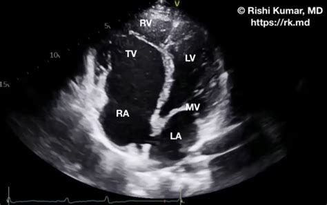 Ebstein Anomaly Rk Md