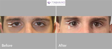 Almond Eye Surgery Before and After Gallery | Taban MD