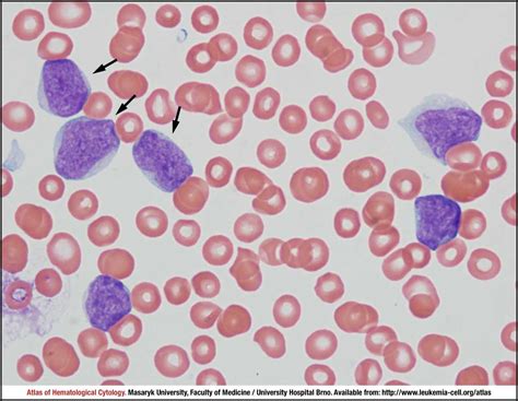 Blastoid Variant Cell Atlas Of Haematological Cytology