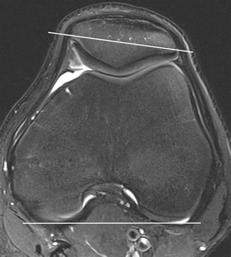 Patellar Tendontrochlear Groove Angle Measurement A New Method For