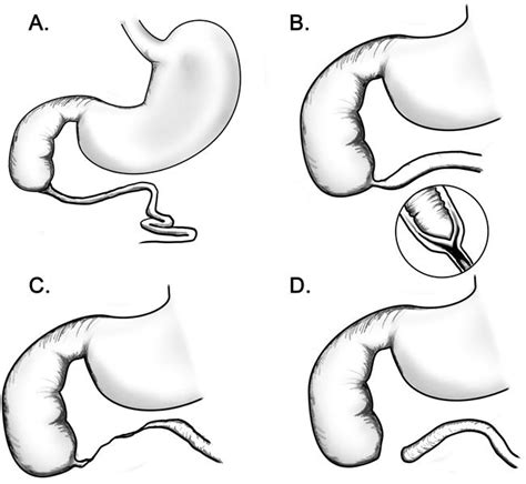 Congenital Duodenal Obstruction Atresia Stenosis And Annular