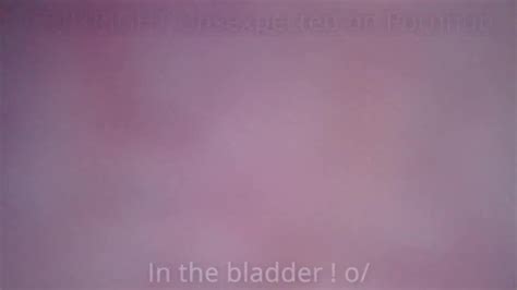 Urethra Bladder Insertion With Diy Endoscope Amateur Xxx Mobile Porno Videos Movies