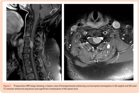 Figure From Spinal Meningiomas Semantic Scholar