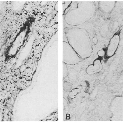 Patient 2. A, glycogen granules are contained in the medullary ...