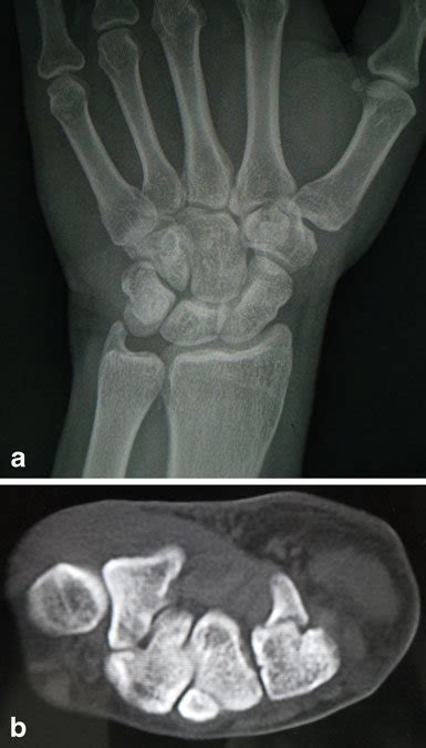 A Follow Up Postero Anterior Radiograph Of The Left Wrist Showing