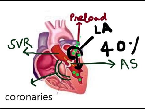 Aortic Stenosis Dr S Parthasarathy Md Dnb Phd Youtube