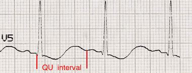 Hypokalaemia ECG Changes LITFL ECG Library