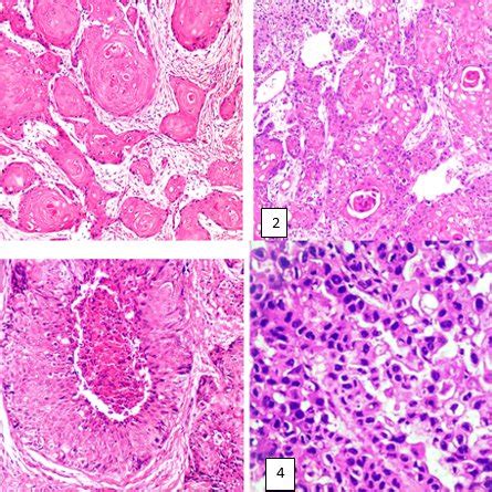 Hematoxylin And Eosin Of Oscc Variable Histological Grades