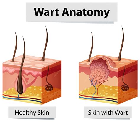 Understanding The Healing Process And How Long For Wart To Fall Off After Freezing Treatments At Home 4