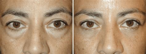 How Can We Fix Hollow Eyes Dr Adam Scheiner