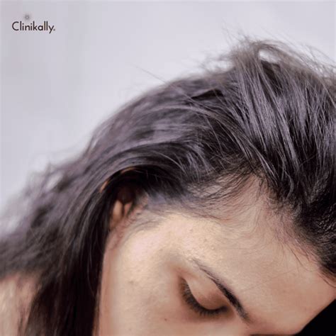 Procapil vs. Redensyl for Hair Fall (Doctor's Guide) | Clinikally