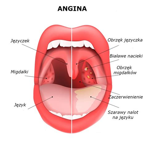 Wirusowe zapalenie gardła czy angina ALFA LEK